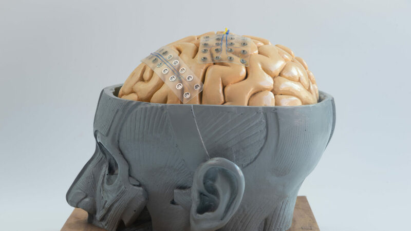 Neuralink : enfoncer un truc dans son cerveau